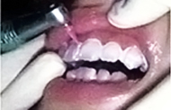 専用のプラスチック製チップの細かい振動によって歯と歯の間、および側面まで磨きます。