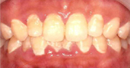 術前：プラーク（バイオフィルム）の除去が不完全なために、歯ぐき全体が腫れています。